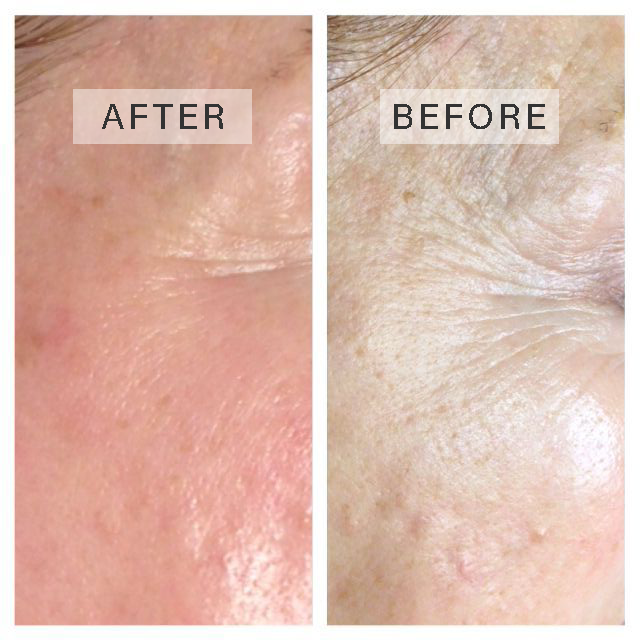 REJUVAPEN NXT MICRONEEDLING IN GULFPORT, MS | Health Fit MD